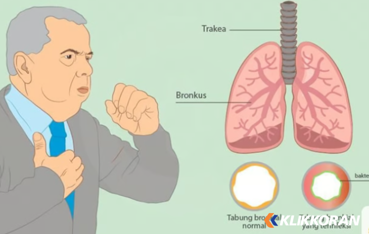 Ilustrasi Saluran Pernapasan Bawah Kronis (foto: SehatQ)