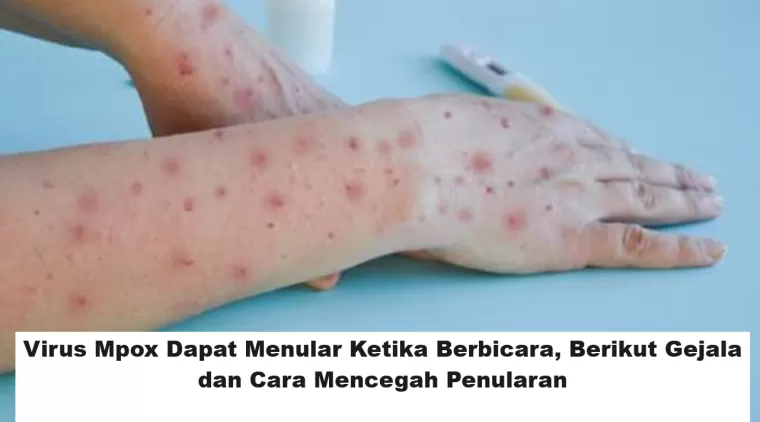 Virus Mpox Dapat Menular Ketika Berbicara, Berikut Gejala dan Cara Mencegah Penularan