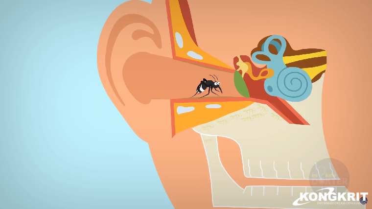 Telinga Kemasukan Serangga, Jangan Buru-buru Ke Dokter, Ini Dia Cara Simple Mengatasinya di Rumah. (Foto : Yt : Ini Kata Dokter)