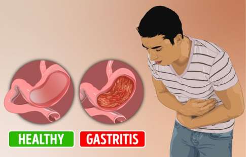 Ilustrasi asam lambung