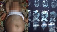 Bayi lima bulan hamil di Pesisir Selatan. (Foto: Tribun)