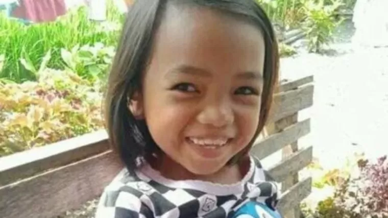 Aldelia siswi SD di Padang Pariaman yang dibakar temannya disekolah. (Foto: Istimewa)